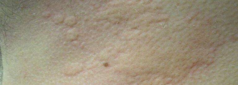 What Are The Symptoms of An Asbestos Rash? - The Law Offices of ...